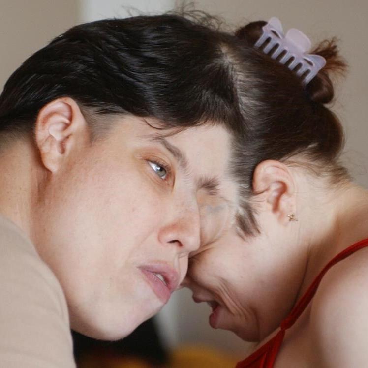 Oldest living conjoined twins, Lori and George Schappell, die at 62